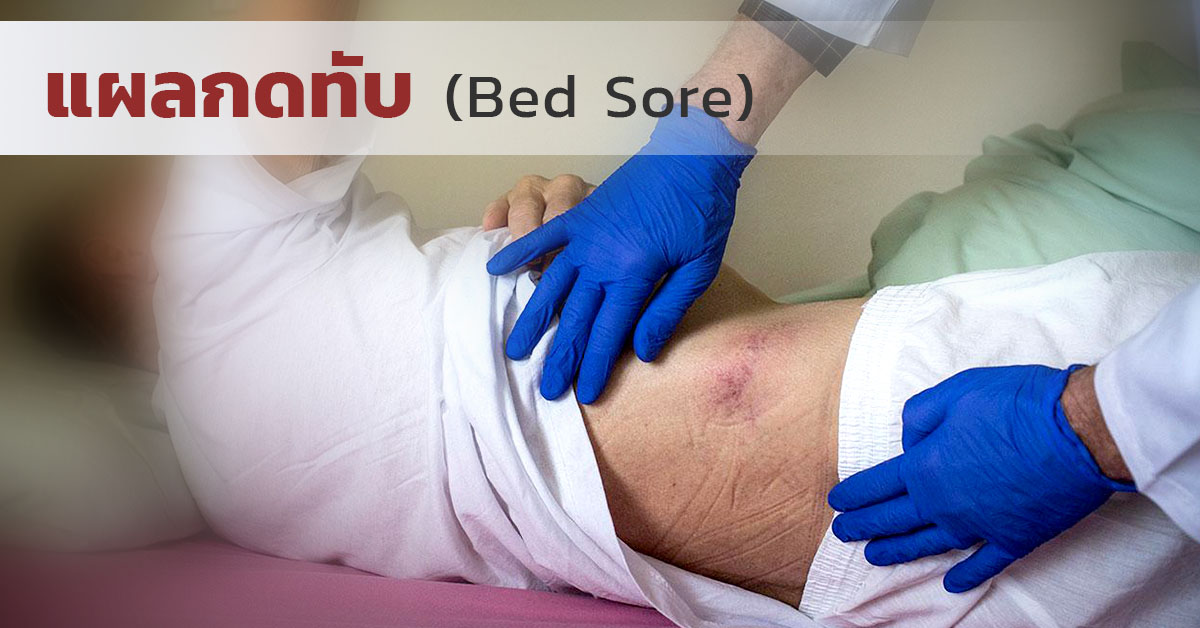 แผลกดทับ (Bed Sore)