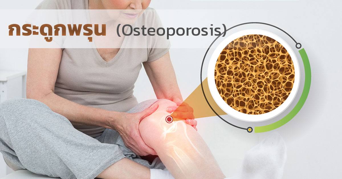 กระดูกพรุน Osteoporosis มวลกระดูกมีความหนาแน่นลดลง