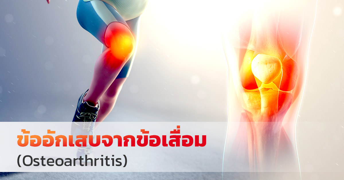 ข้ออักเสบจากข้อเสื่อม (Osteoarthritis)